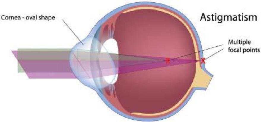 The corneal surface is too steeply curved so images focus in front of the retina causing blurred vision.