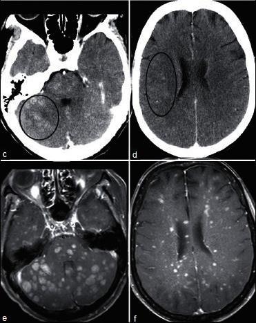Ultra-High Field (UHF) MRI MRI w Gd leads in BM detection CECT 20% of patients who present with a single lesion on CT