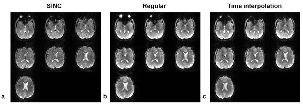 Figure 5.10 Multiple brain slices with EPI sequence using three different sets of RF pulses for the comparison of signal recovery on one representative subject. The signal loss in Fig. 5.10a has been successfully recovered in Figs 5.