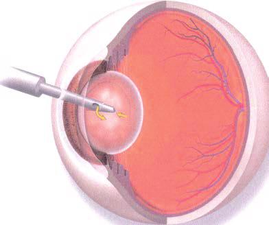 place an artificial lens (IOL) in your eye, your natural lens is removed first through an incision.