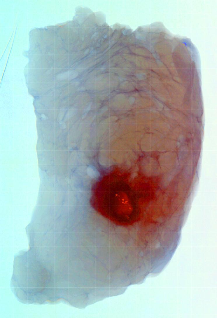 Breast carcinoma specimen Poorly differentiated invasive duct type. 10cm blue arrows: normal fat tissue( lobules ) B. Dierickx, N. Buls, C. Bourgain, C. Breucq, J. Demey, B. Dupont, A.