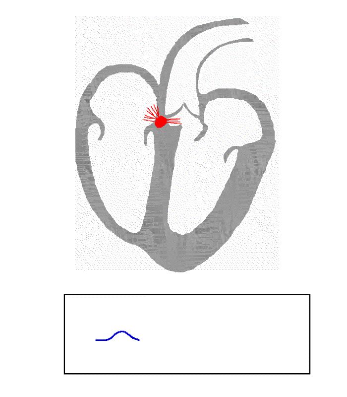 Research background is a common form of heart disease Catheter ablation with RF radiation is a proven technique to remove Ideally ECG indicates the location of umie
