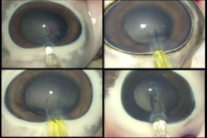 Smooth IOL unfolding after insertion Indented haptic surface prevents sticking to the optic after release.