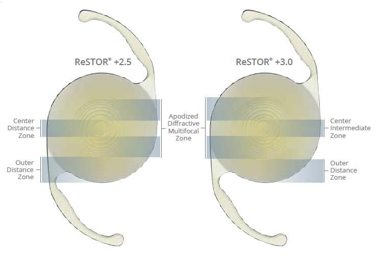 Optic Design Differences: ReSTOR +2.5 vs ReSTOR +3.0 Reduced the add power to 2.5 from 3.