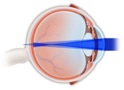 Refractive errors: astigmatism In astigmatism, the cornea is curved unevenly shaped more like a football than a basketball.