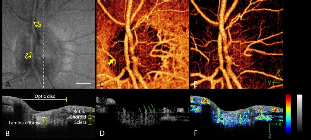 The ONH angiogram obtained by the SSADA algorithm showed both many orders of vascular branching as well as the microcirculatory network. The en face maximum decorrelation projection angiogram (Fig.