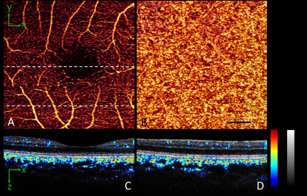 intensity image with the color scale flow (decorrelation) image showed that the major retinal branches vessels were at the level of the peripapillary NFL (Fig. 4(F)).