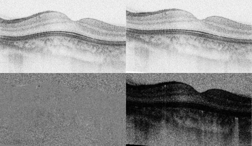 A B C D Fig. 5. (1.3 MB) A sequence of OCT images and flow images of the human eye. Each image comprises 4000 A-lines and has a size of 5 mm 1 mm (lateral depth).