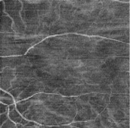 Fig. 9. Optical coherence angiography of the macula lutea of the human eye.