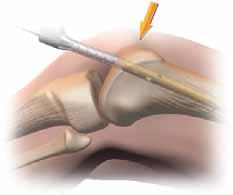 Proximal In the AP view, confirm that the nail has been inserted to the desired depth.