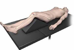 Surgical Technique Patient Positioning Position the patient supine on a radiolucent table. Flex the affected limb approximately 45 over a posterior support to assist with fracture reduction.