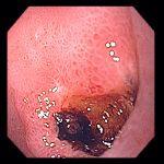 Endoscopia arată un mare cheag "santinelă" găsit într-un ulcer duodenal; HDS cu
