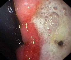 C membrane hematice Endoscopia superioară arată un ulcer gastric benign, dar