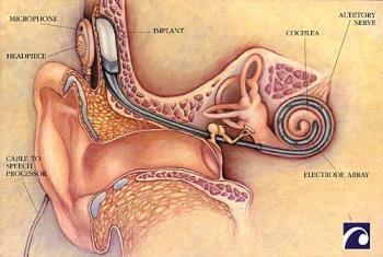 Loud Sounds Trample Hair Cells Cochlear Implant (p.