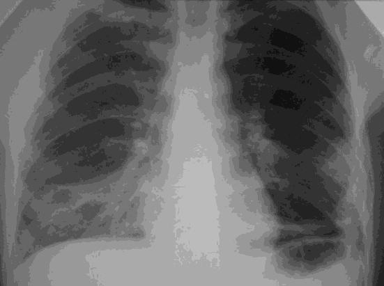 Real pneumonia fluorography before processing and after processing the developed method, shown in Figure 6.
