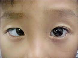 H.I. of the EXTRINSIC MUSCLE STRABISMUS Weak eye
