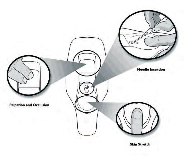 Training Sequence The haptic device contains three (3) separate regions: (1) The top of the device is for vein palpation and occlusion, (2) The middle of the device is for needle insertion, and (3)