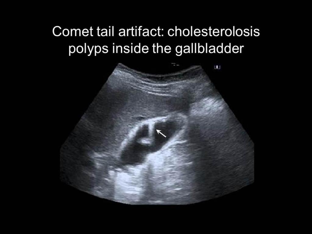 Fig. 5: Cholesterolosis polyps