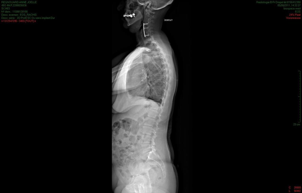 Fig. 2: F49, EOS full spine AP view. Fig.