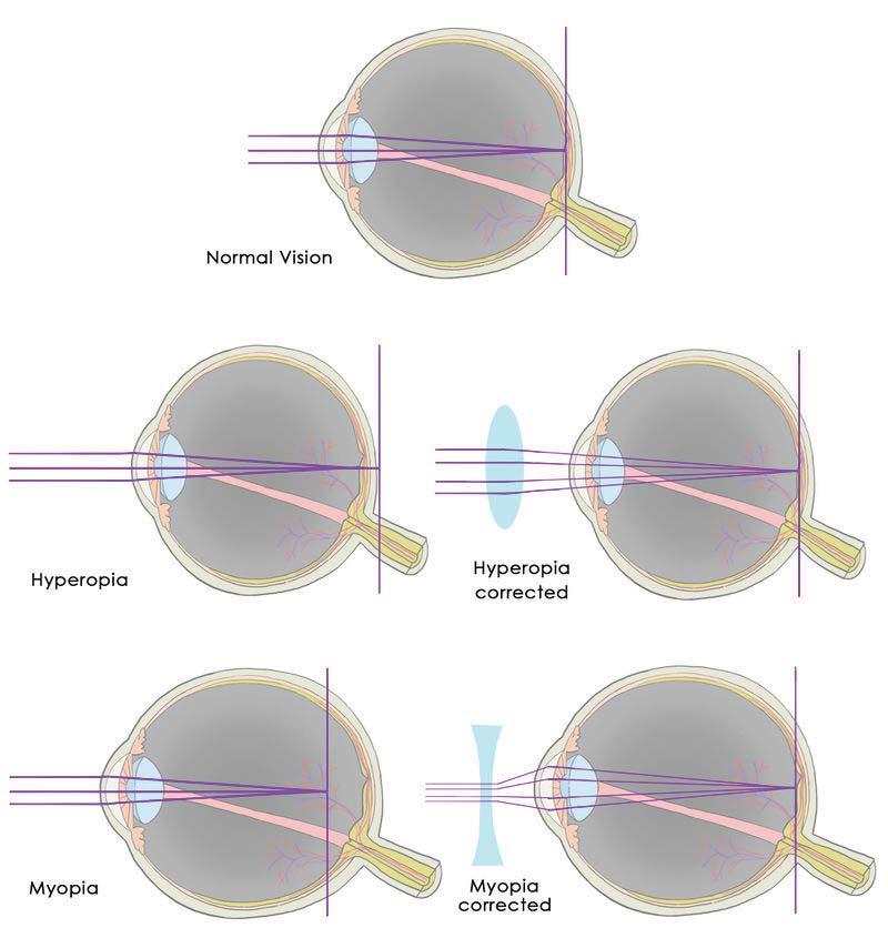 www.ck12.org Chapter 9. Visible Light FIGURE 9.26 Myopia and hyperopia can be corrected with lenses. Lesson Review Questions Recall 1. How are the pupil and iris related? 2.