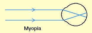refractive error is present 43 diopters Myopia: Near sightedness 24-25mm Hyperopia (Hypermetropia): Far sightedness 18 diopters Presbyopia: Loss of accommodative ability of the lens resulting in