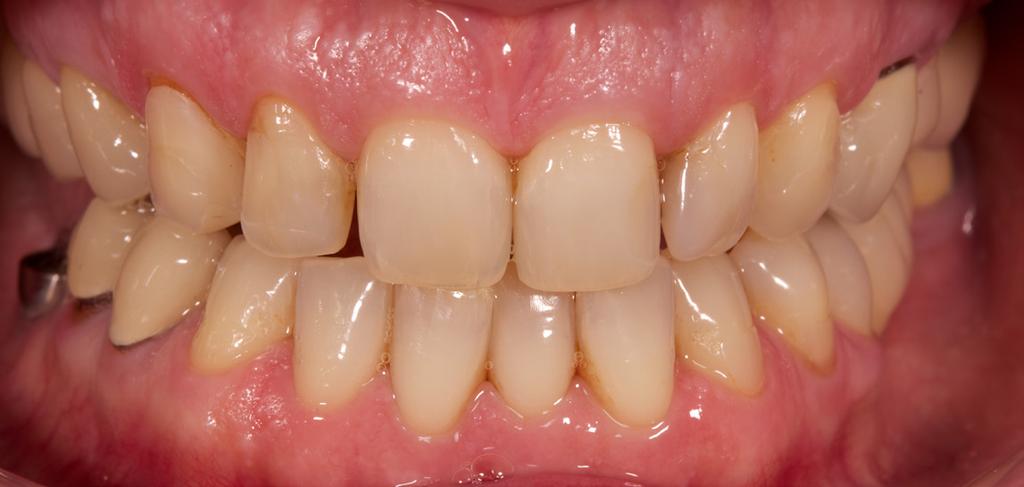 dentition Very stable color and value even after multiple firings Dense, porosity free surface that mimics
