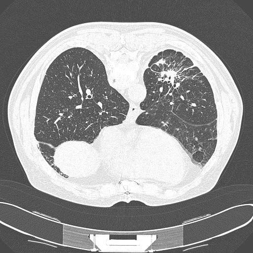Medical Imaging Enhance imagery, or iden<fy important phenomena or events, or visualise informa<on obtained by imaging Parenchymal bands: linear structures touching the lung boundary Segment and