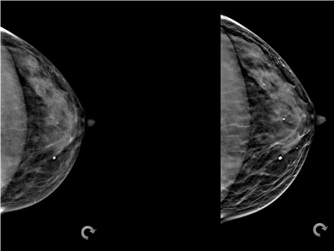visible on both projection & tomosynthesis datasets Tomosynthesis Reconstruction More difficult to detect/confirm motion on reconstruction Unsharpness in the tomosynthesis dataset