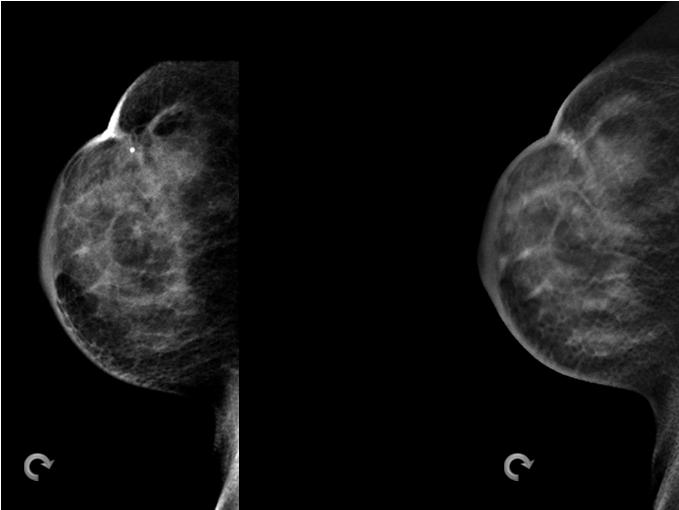 If objects in the breast seem to wiggle and bounce anterior to posterior, consider motion 2012 Hologic, Inc.