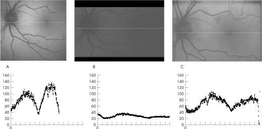 Figure 4: Fundus auto fluorescence (FAF) images and corresponding grey scale values in a normal subject. Dr.