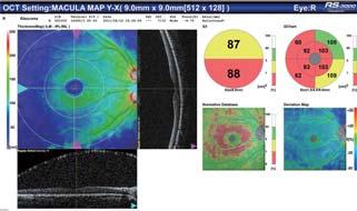 module enables observation and analyses of the anterior segment.