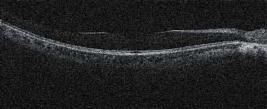 OCT-Angiography (3 x 3 mm)