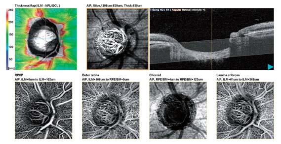 Disc Map ONH (optic nerve head) and RNFL (retinal nerve fiber layer) thickness can be examined.