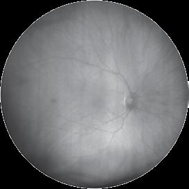 of the retina, especially of vasculature and
