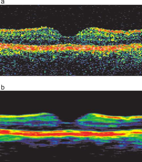 IOVS, June 2005, Vol. 46, No. 6 Macular Segmentation with Optical Coherence Tomography 2013 2.