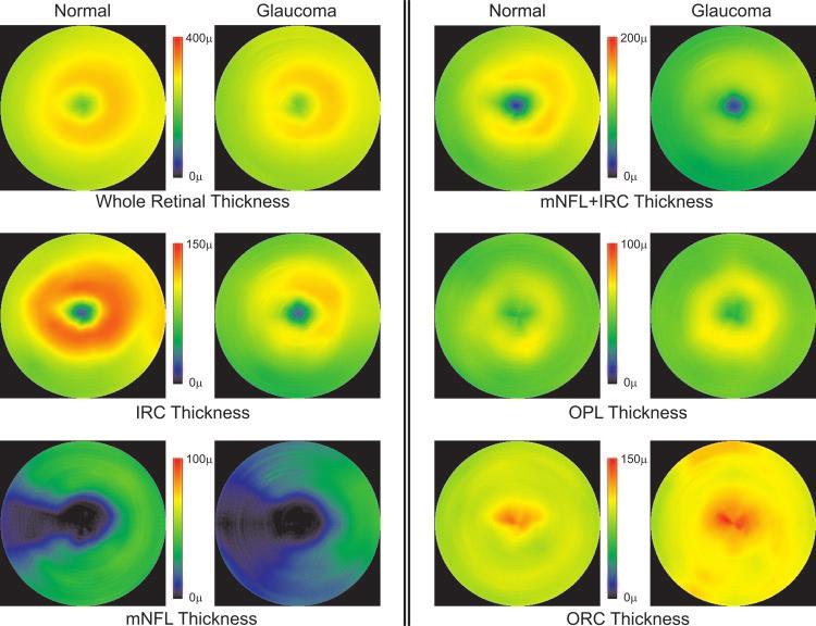 IOVS, June 2005, Vol. 46, No. 6 Macular Segmentation with Optical Coherence Tomography 2015 TABLE 3.