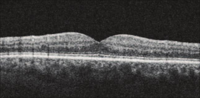 Similarly, a pupil location above or below the on-axis scan pupil location would induce a tilt in the B-scan corresponding to the vertical axis. OS junction and Bruch s membrane.