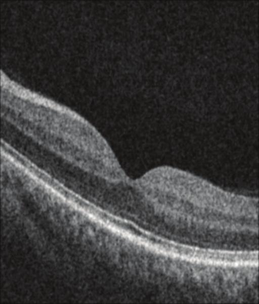 Figure 6. A central B-scan from an example on-axis and two off-axis scans obtained from a normal subject. The segmented RPE and Bruch s membrane have been overlaid on the B-scan.