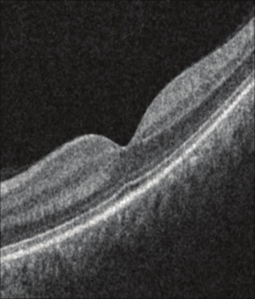 scans due to the increased retinal curvature, with diminished signals Figure 8.