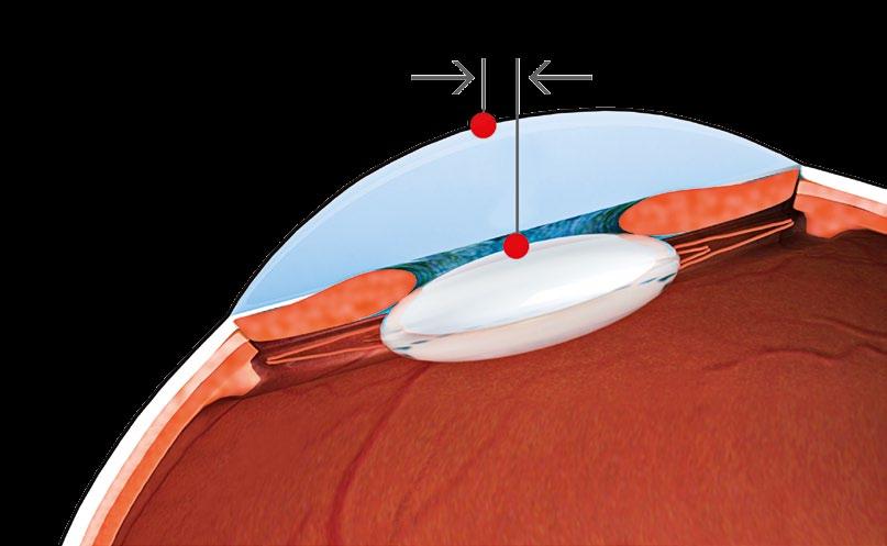 Consequently, precise centration and constant positioning of the eye is vitally important if high precision is to be achieved with eye laser surgery.