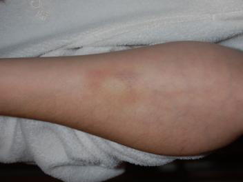 Flash positioning and power settings can make a difference with bruises. Shin, calf, arm or?