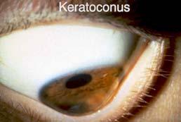 astigmatism i. detached n. conjuntivitis retina e.