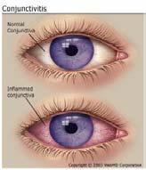 conjunctivitis (conditions known as pink-eye )