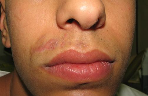 Pigmentation 17 Scar 15 Acne Scars 1 Year After 1 Photos: