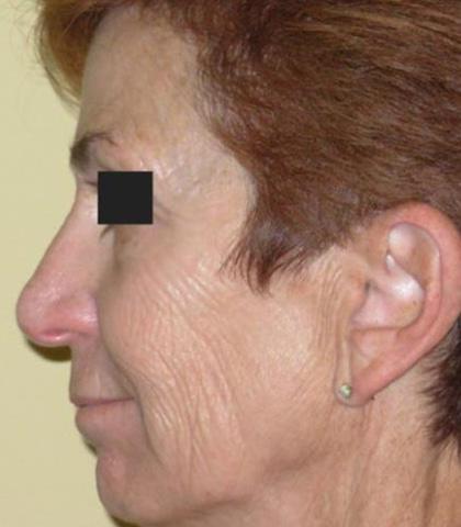 reduction, pigmentation, minor dermal incisions and