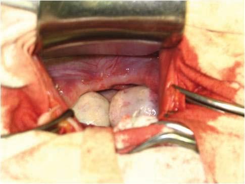 Folosirea laparoscopiei permite vizualizarea mai bună a peritoneului prin faptul iluminării lui cu sursa de lumină [2, 6].