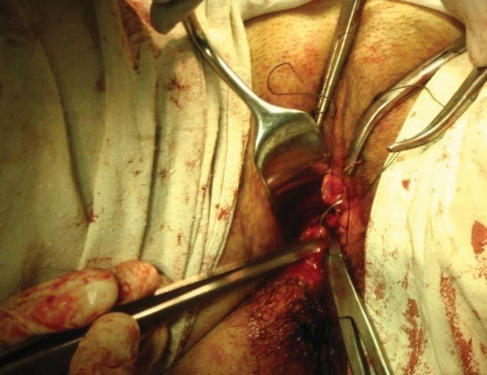 pereţii laterali a bazinului mic şi colonului sigmoid [6]. Fixarea boltei de rudimentele uterine previne prolapsul vaginului artificial [6].