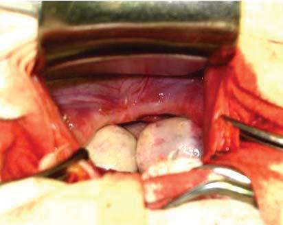 Organele bazinului mic în sindromul MRKH: ovare dezvoltate şi situate normal A0 (*) tul operaţiei se depistează o retractare a pielii perineului în direcţia vaginului artificial şi, respectiv,