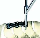 An awl is available for perforation of the cortex, or as an alternative to drilling.