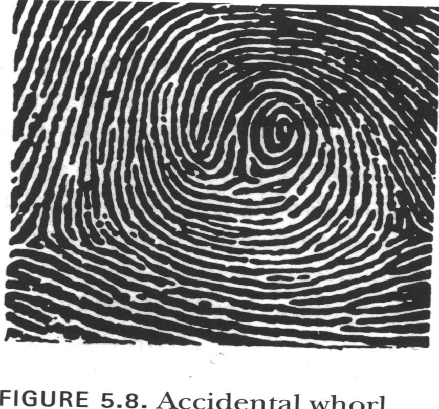 Accidental Whorl Has two or more deltas and is a